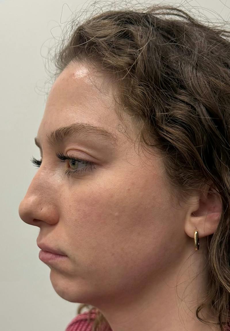 Results Before & After Gallery - Patient 298739 - Image 3