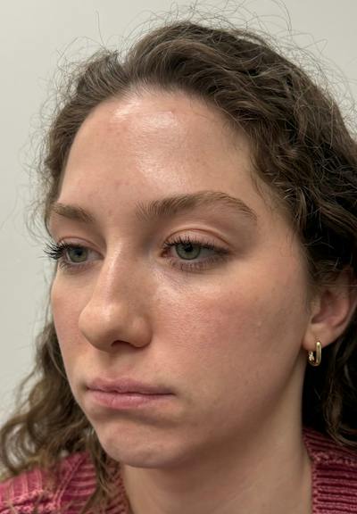 Results Before & After Gallery - Patient 298739 - Image 1