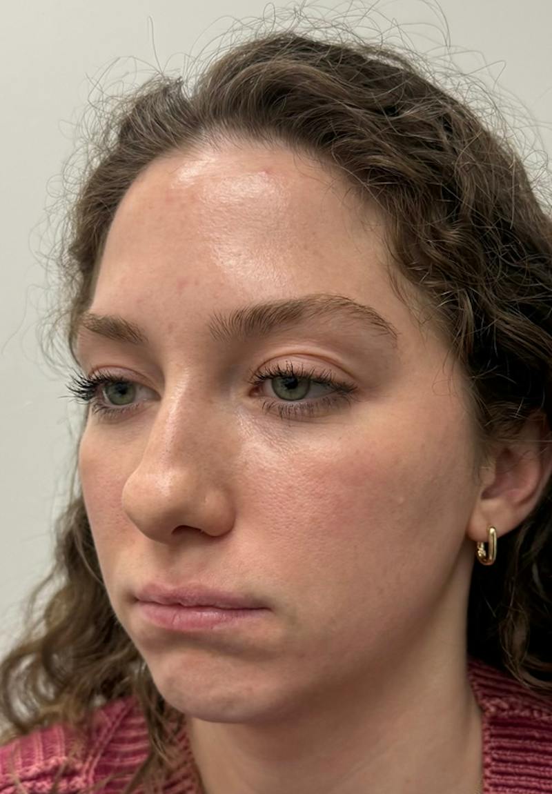 Results Before & After Gallery - Patient 298739 - Image 1