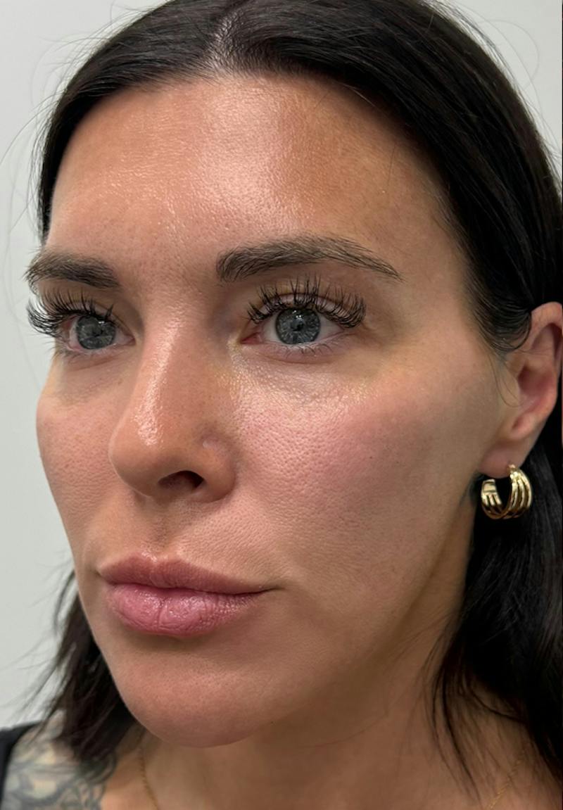 Results Before & After Gallery - Patient 135835 - Image 2
