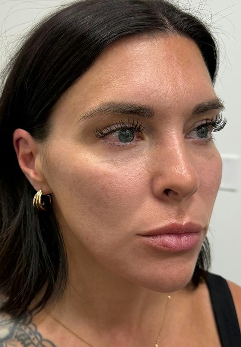 Results Before & After Gallery - Patient 135835 - Image 4