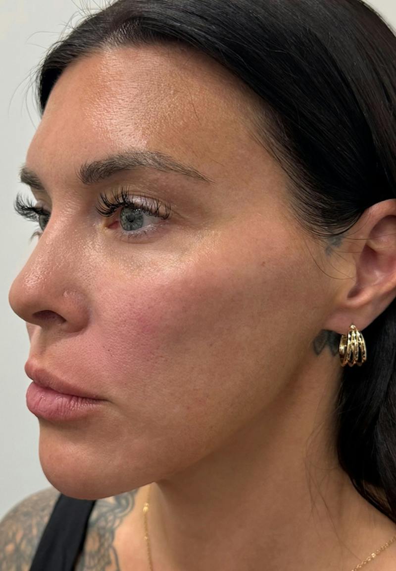 Results Before & After Gallery - Patient 135835 - Image 6