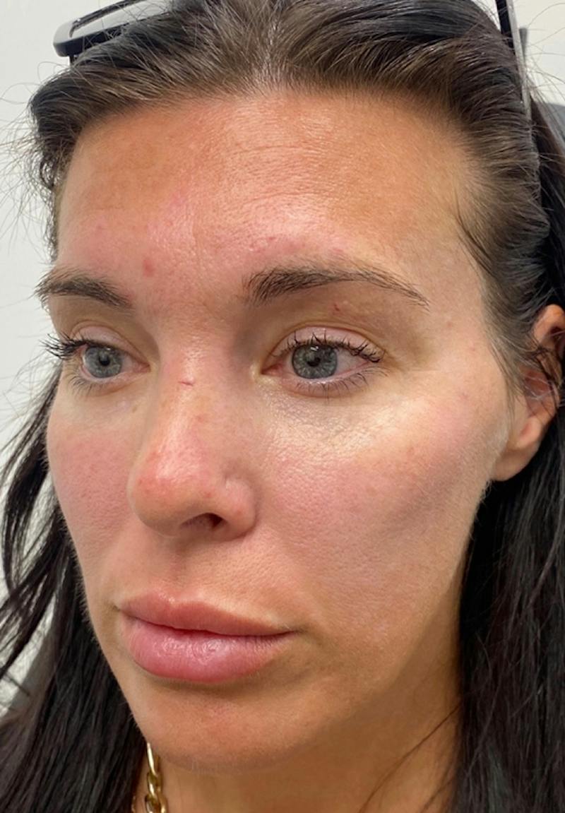 Results Before & After Gallery - Patient 135835 - Image 1