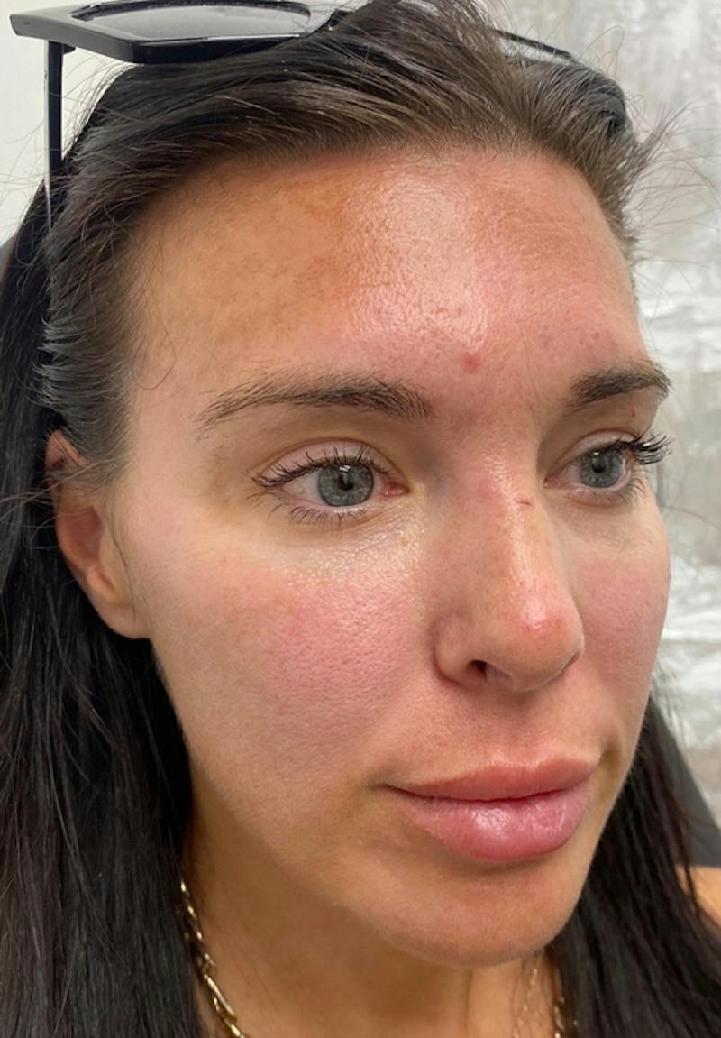 Results Before & After Gallery - Patient 135835 - Image 3
