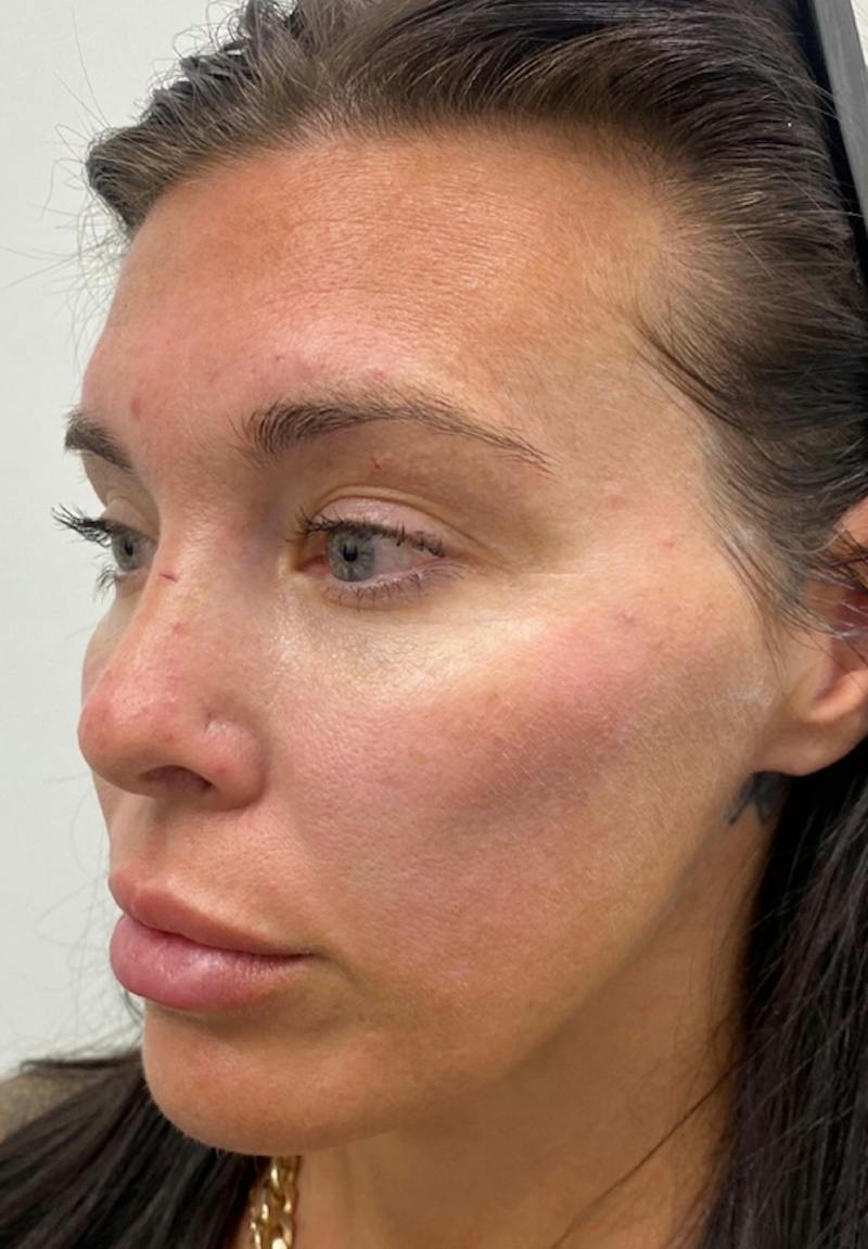 Results Before & After Gallery - Patient 135835 - Image 5
