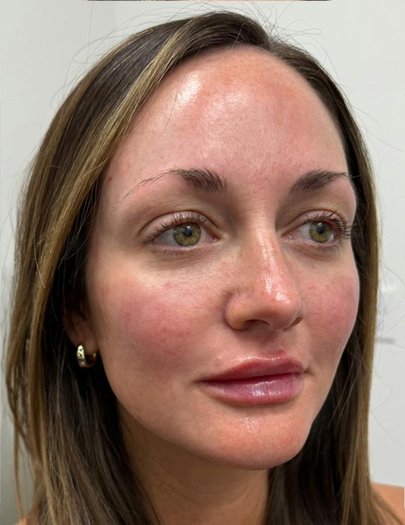 Results Before & After Gallery - Patient 209010 - Image 4