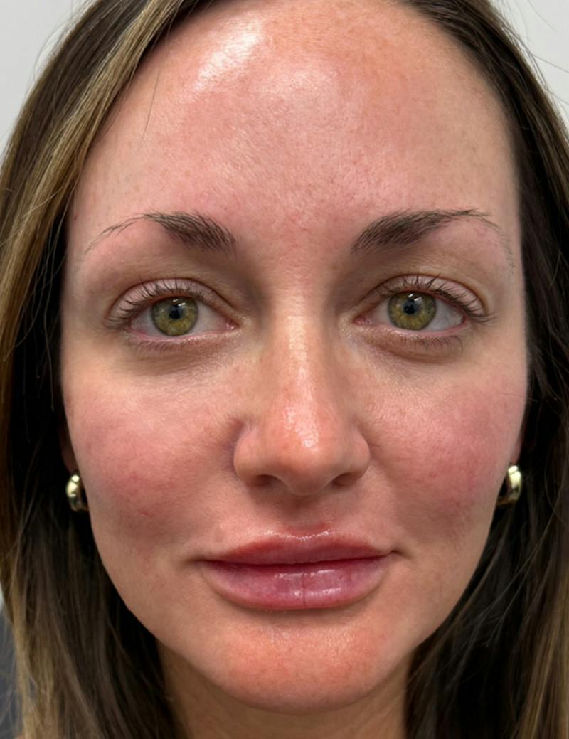 Results Before & After Gallery - Patient 209010 - Image 2