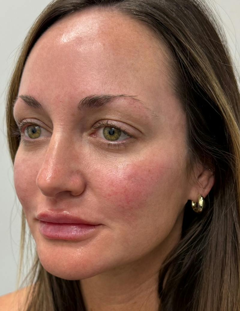 Results Before & After Gallery - Patient 209010 - Image 6