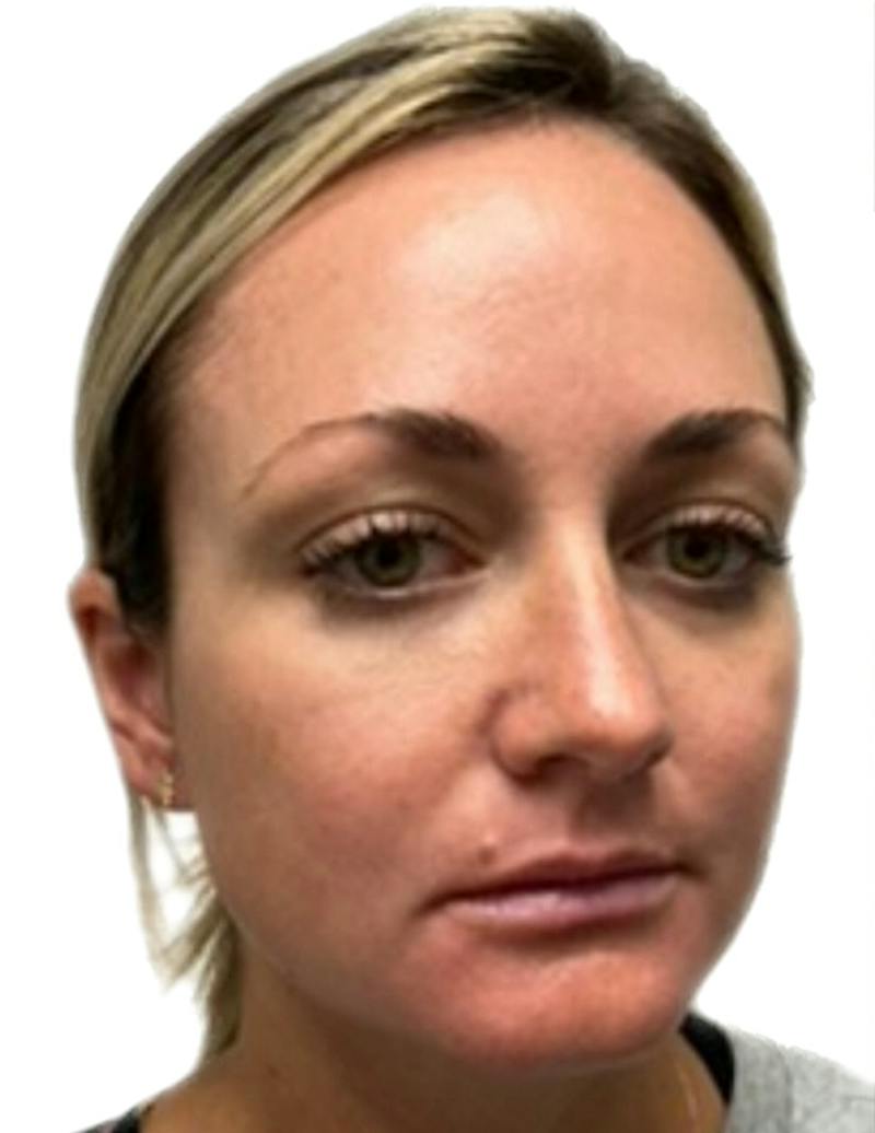 Results Before & After Gallery - Patient 209010 - Image 3