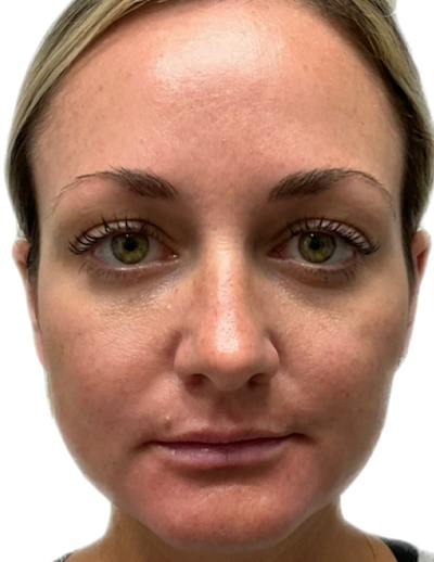 Results Before & After Gallery - Patient 209010 - Image 1