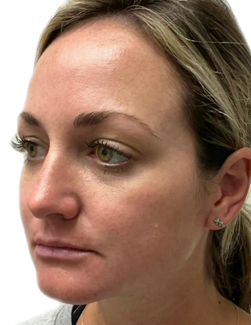 Results Before & After Gallery - Patient 209010 - Image 5