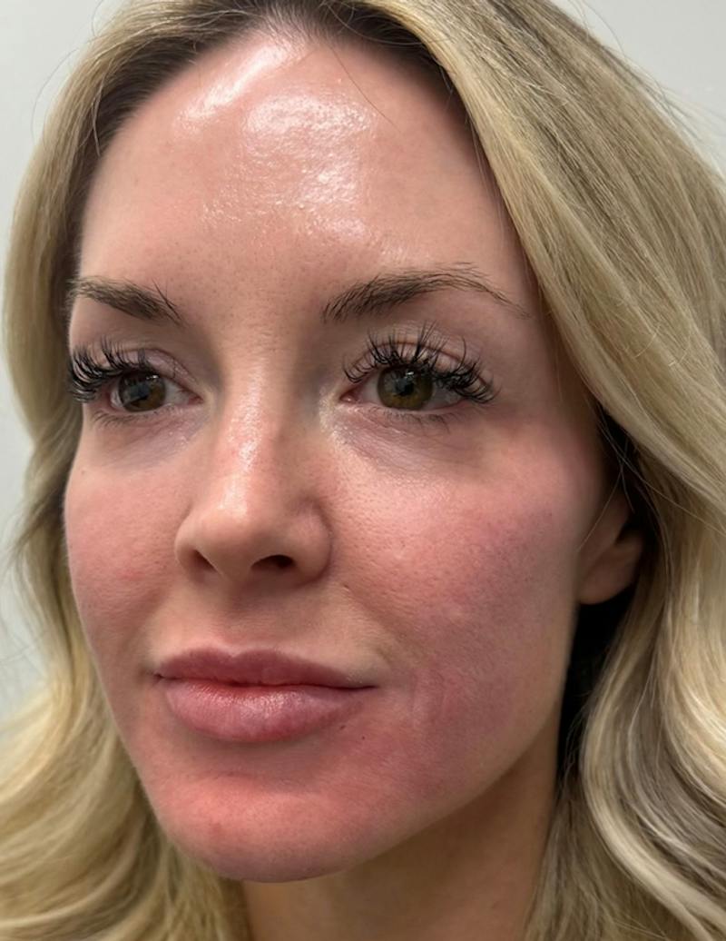 Results Before & After Gallery - Patient 368942 - Image 2