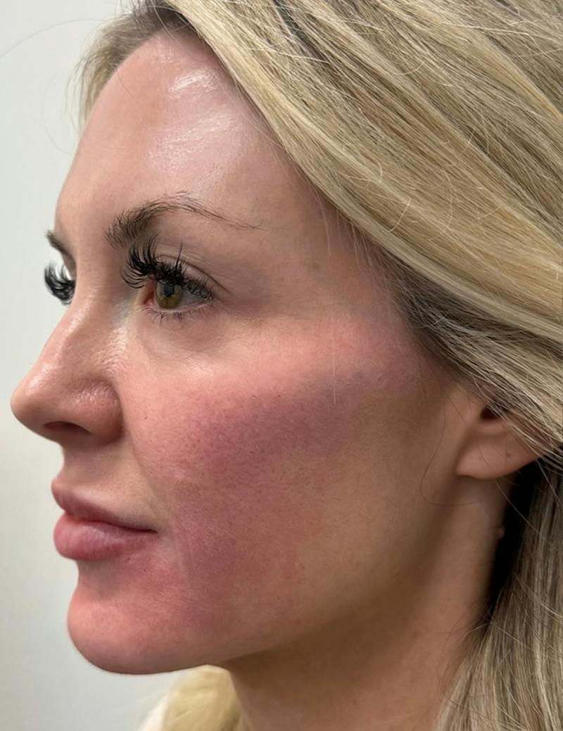 Results Before & After Gallery - Patient 368942 - Image 3