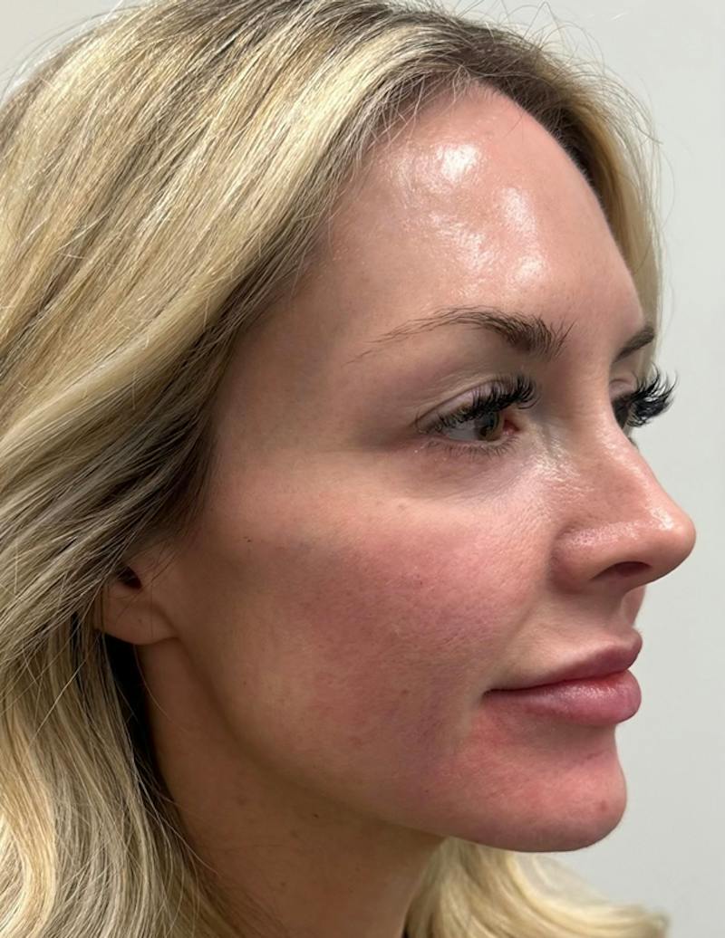 Results Before & After Gallery - Patient 368942 - Image 6