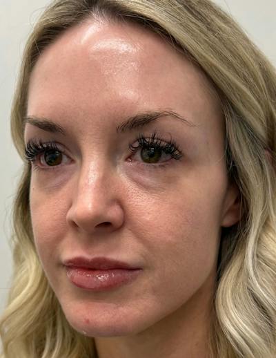 Results Before & After Gallery - Patient 368942 - Image 1