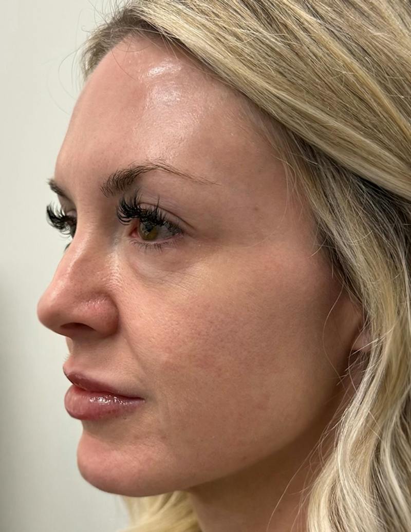 Results Before & After Gallery - Patient 368942 - Image 4