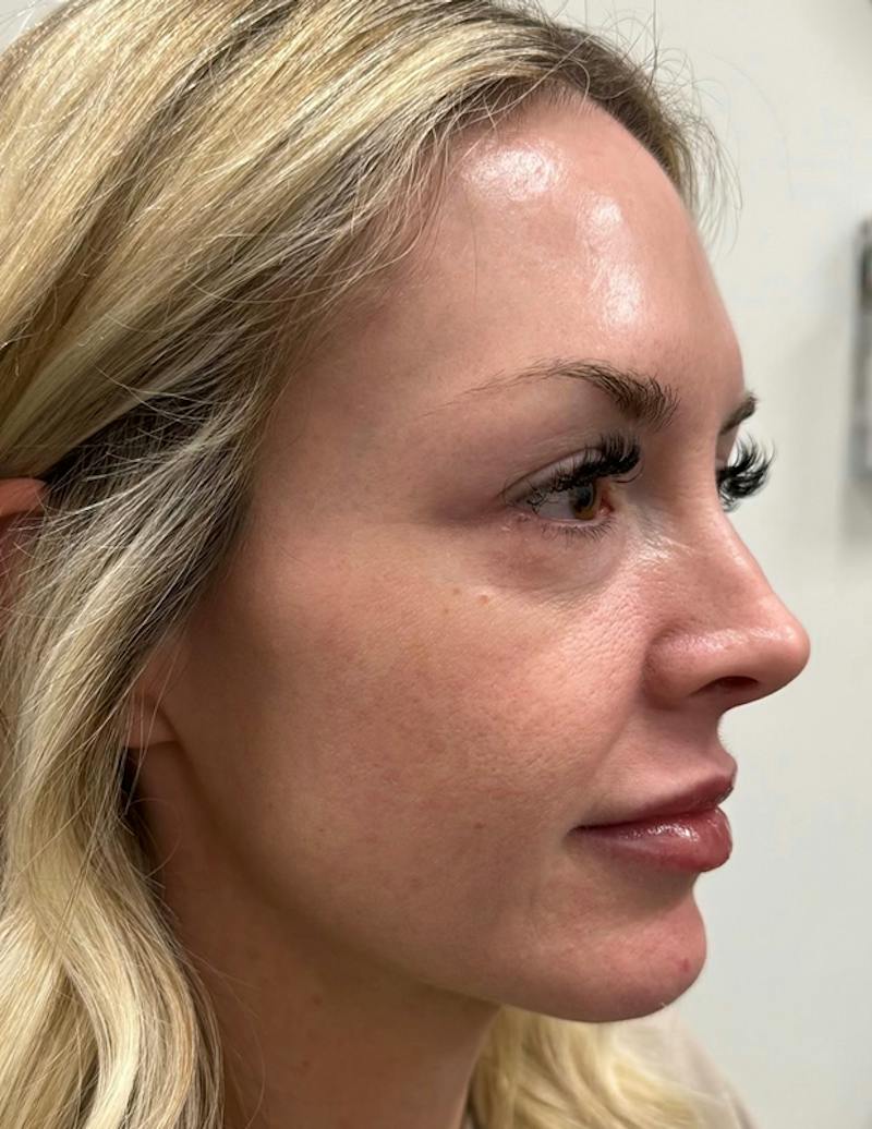 Results Before & After Gallery - Patient 368942 - Image 5