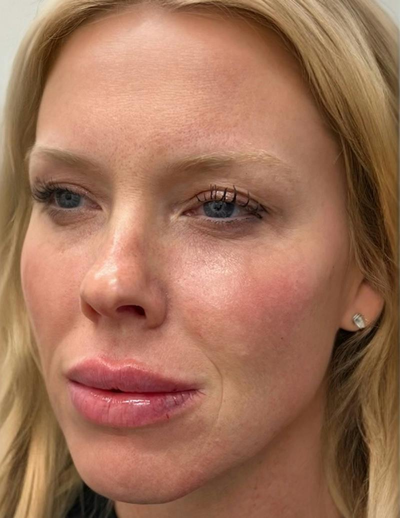 Results Before & After Gallery - Patient 488211 - Image 4