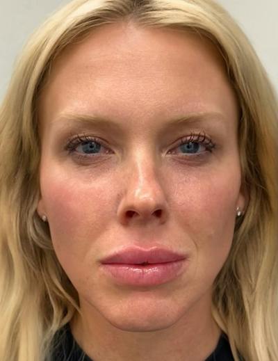 Results Before & After Gallery - Patient 488211 - Image 2
