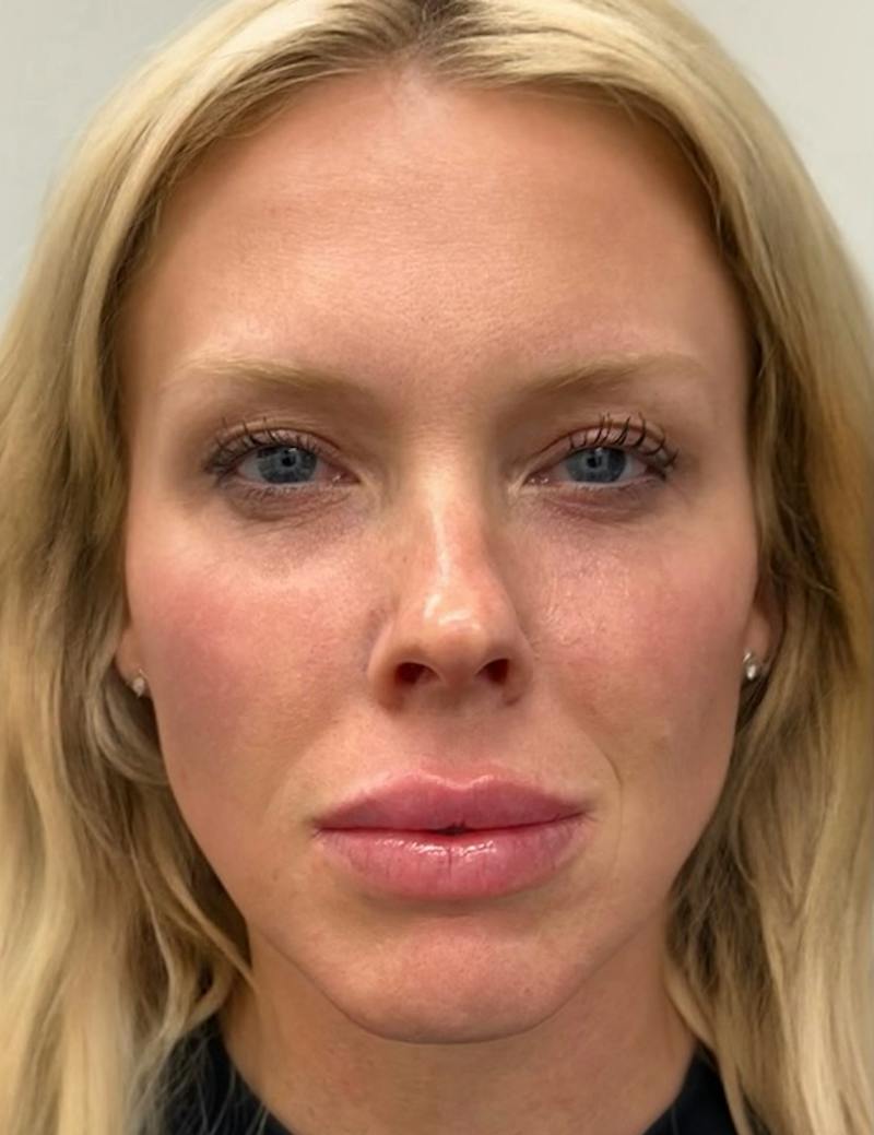 Results Before & After Gallery - Patient 488211 - Image 2