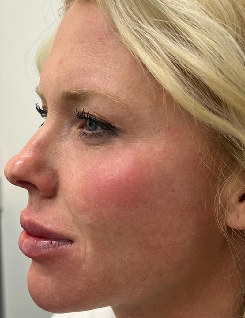 Results Before & After Gallery - Patient 488211 - Image 6