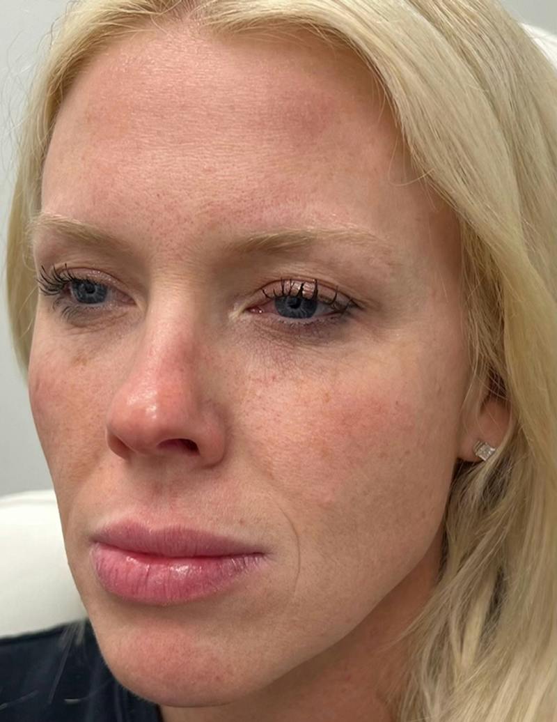 Results Before & After Gallery - Patient 488211 - Image 3
