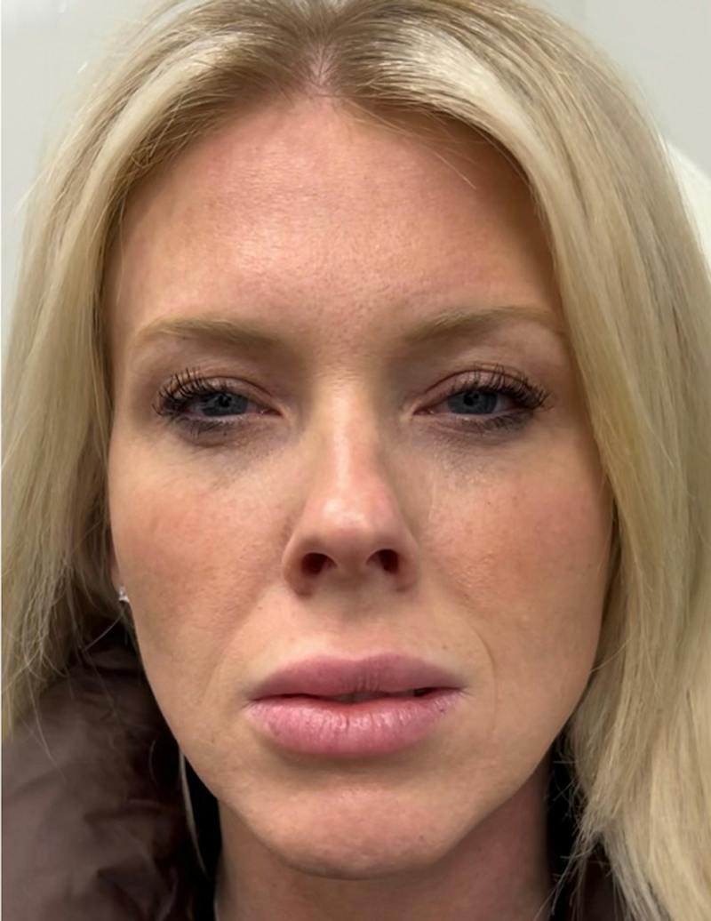 Results Before & After Gallery - Patient 488211 - Image 1