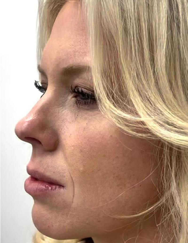 Results Before & After Gallery - Patient 488211 - Image 5