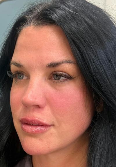 Results Before & After Gallery - Patient 309255 - Image 2