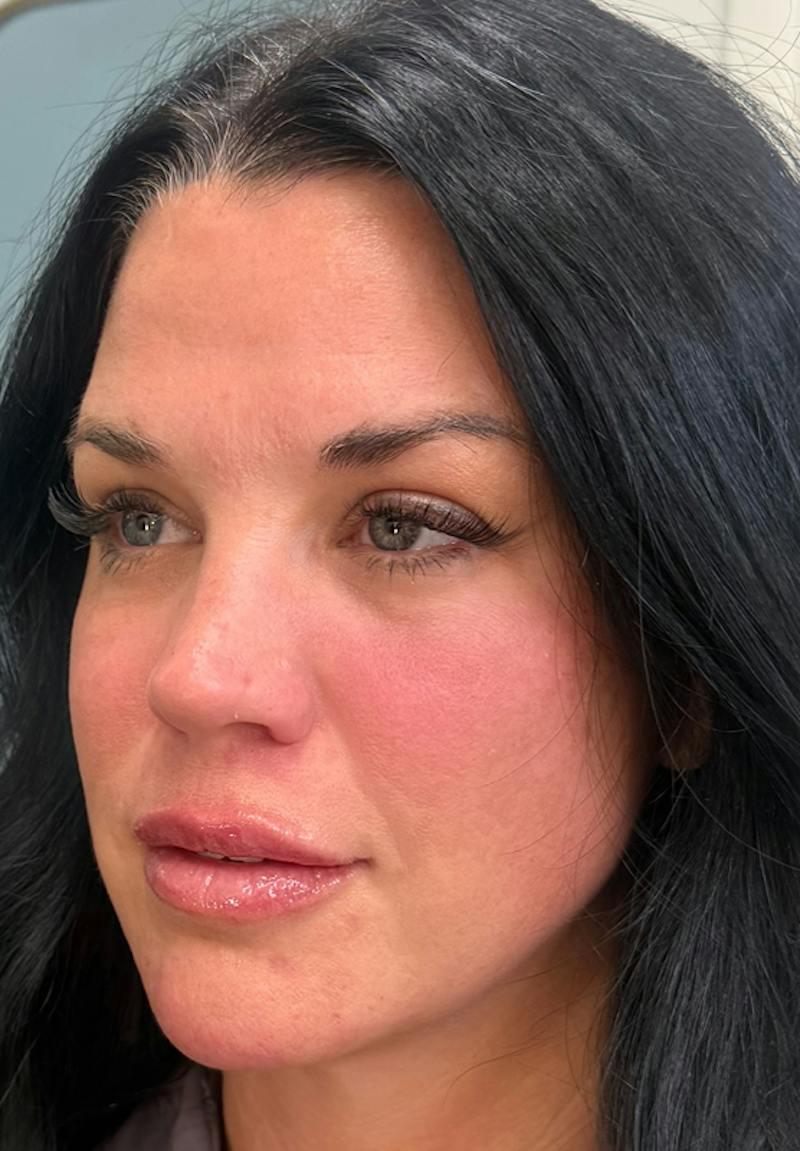 Results Before & After Gallery - Patient 309255 - Image 2