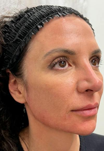 Results Before & After Gallery - Patient 123871 - Image 2