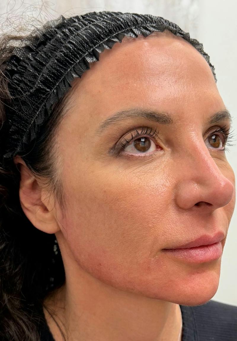 Results Before & After Gallery - Patient 123871 - Image 2