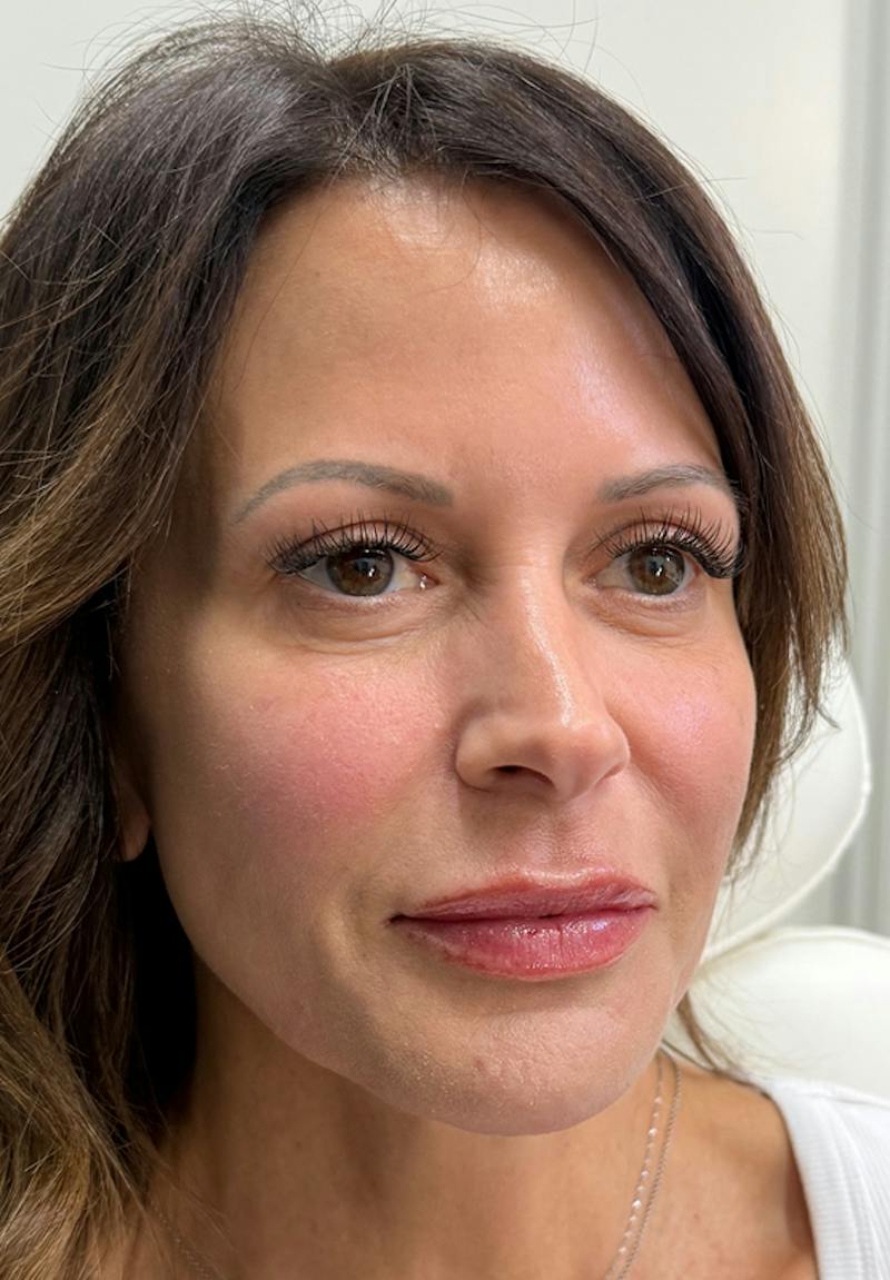 Results Before & After Gallery - Patient 746000 - Image 2