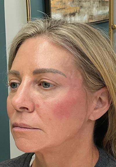 Results Before & After Gallery - Patient 353661 - Image 2