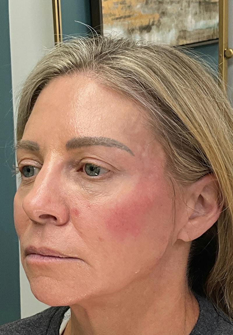 Results Before & After Gallery - Patient 353661 - Image 2