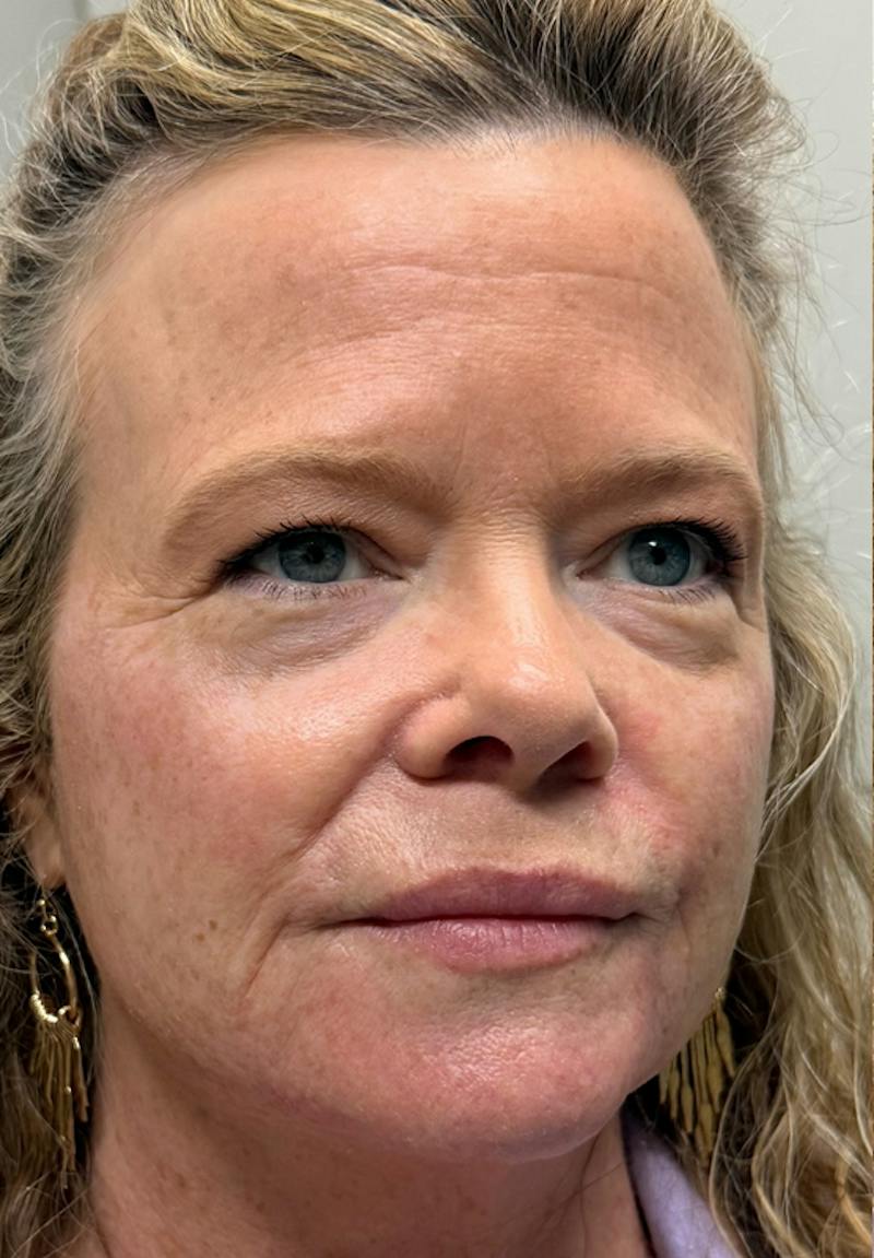 Results Before & After Gallery - Patient 358975 - Image 1