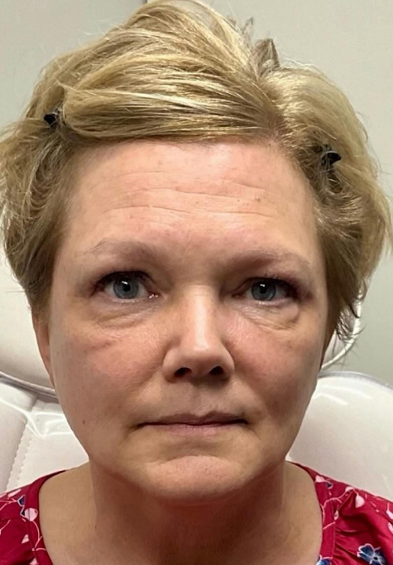 Results Before & After Gallery - Patient 599364 - Image 1