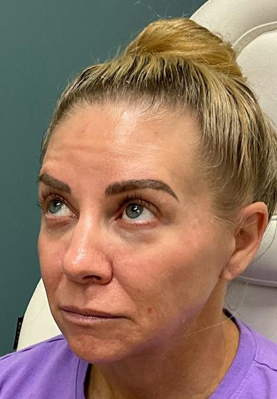 Results Before & After Gallery - Patient 353661 - Image 1