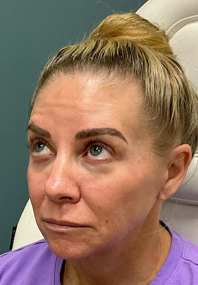 Results Before & After Gallery - Patient 353661 - Image 1