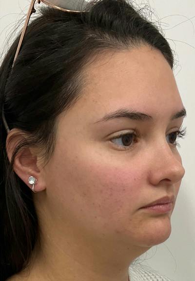 Results Before & After Gallery - Patient 110364 - Image 1