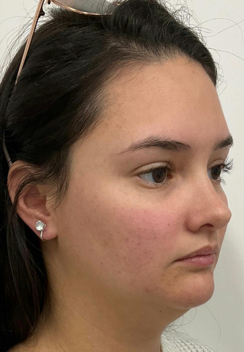 Results Before & After Gallery - Patient 110364 - Image 1