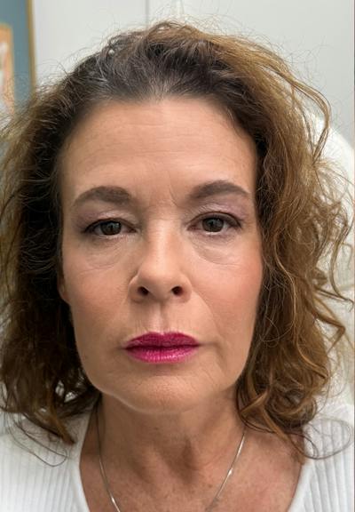 Results Before & After Gallery - Patient 150897 - Image 2