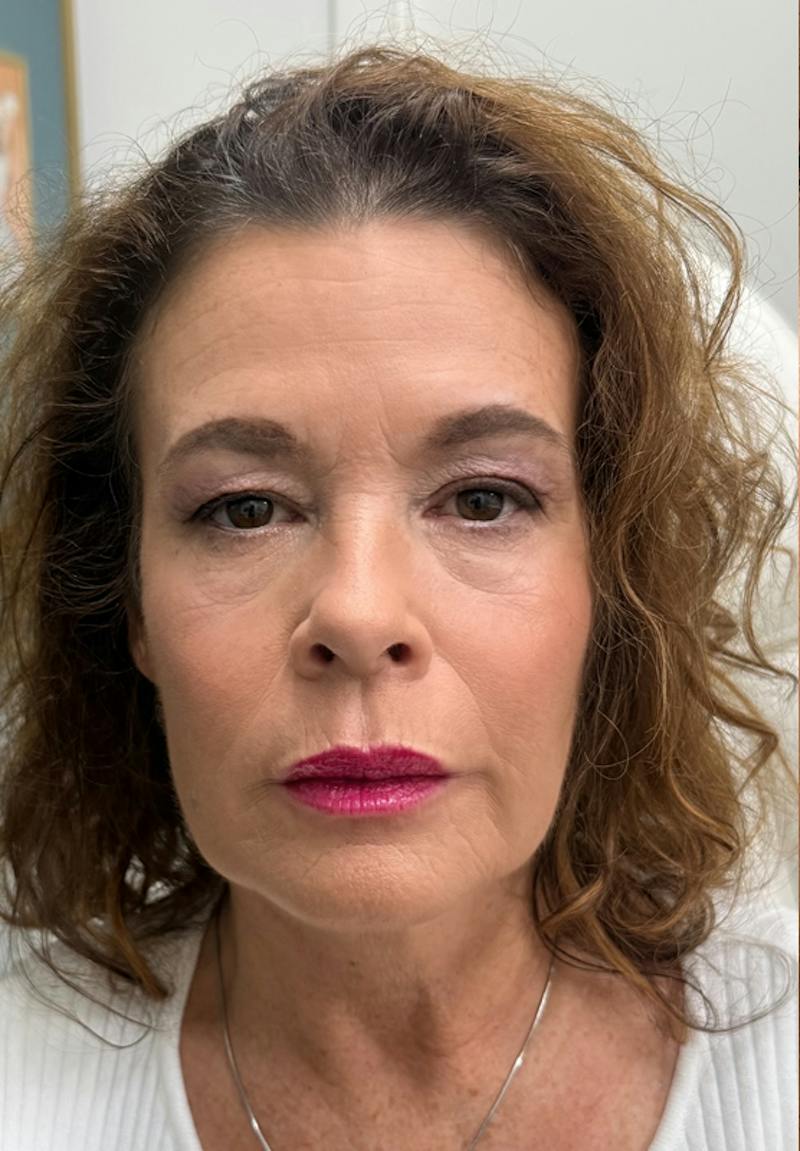 Results Before & After Gallery - Patient 150897 - Image 2
