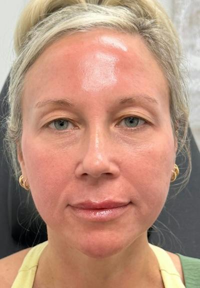 Results Before & After Gallery - Patient 452297 - Image 2