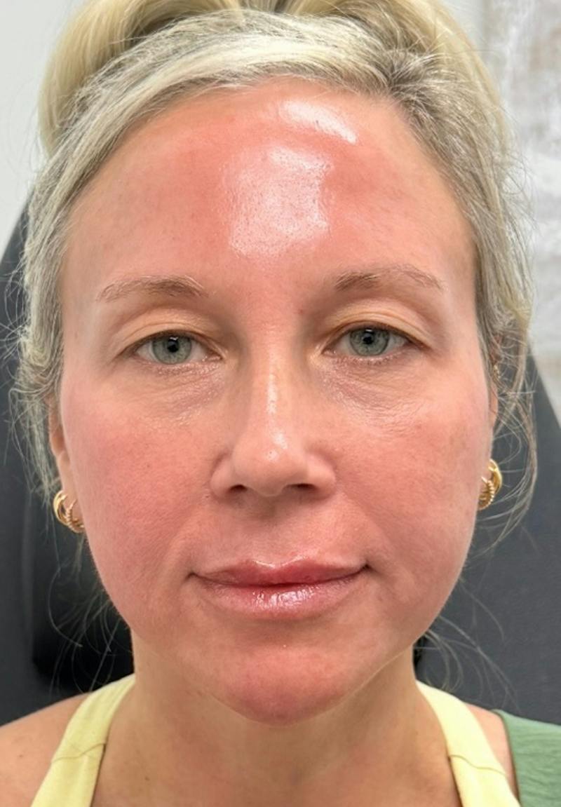 Results Before & After Gallery - Patient 452297 - Image 2