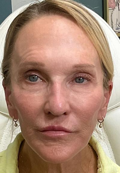 Results Before & After Gallery - Patient 877403 - Image 2