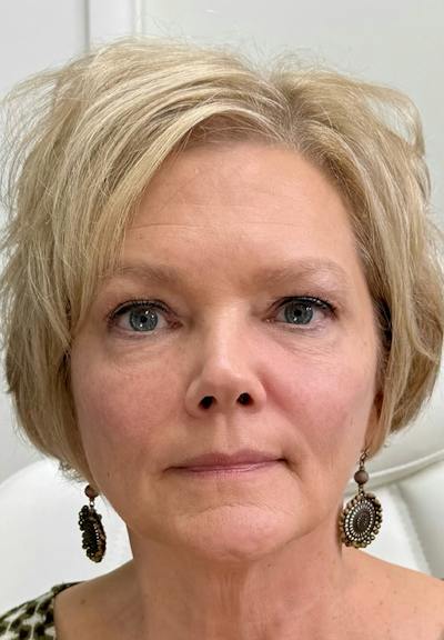 Results Before & After Gallery - Patient 599364 - Image 2