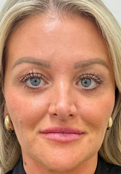 Results Before & After Gallery - Patient 289909 - Image 2