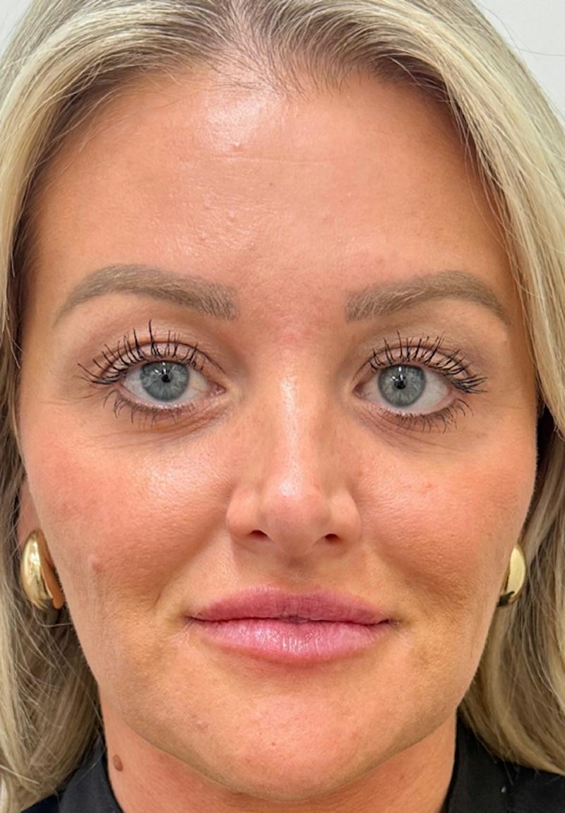 Results Before & After Gallery - Patient 289909 - Image 2