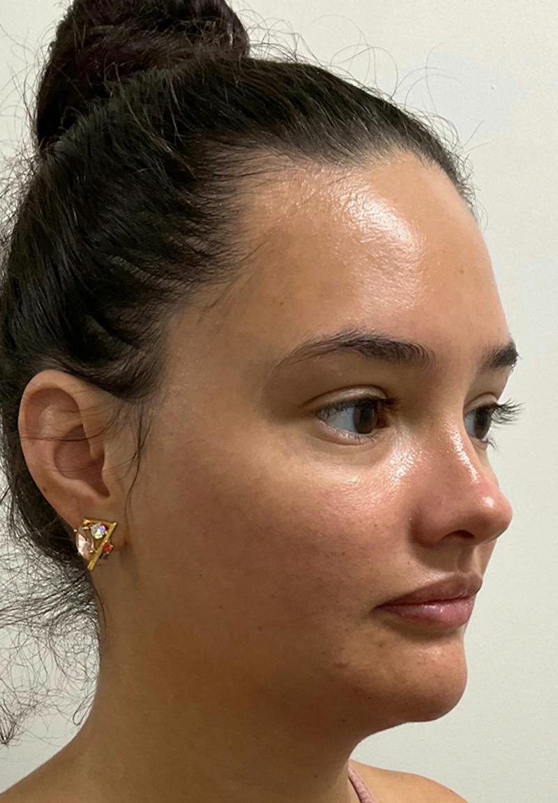 Results Before & After Gallery - Patient 110364 - Image 2